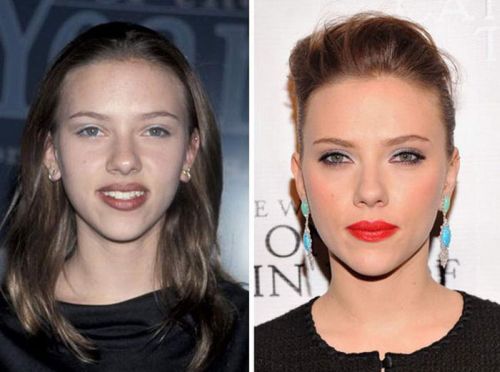 Scarlett Johansson nose job before after