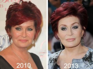 Sharon Osbourne Before and After Plastic Surgery