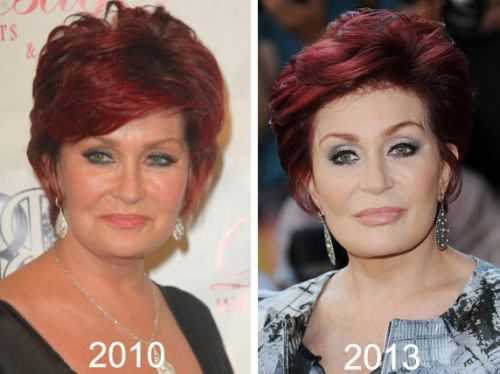 Sharon Osbourne plastic surgery before and after