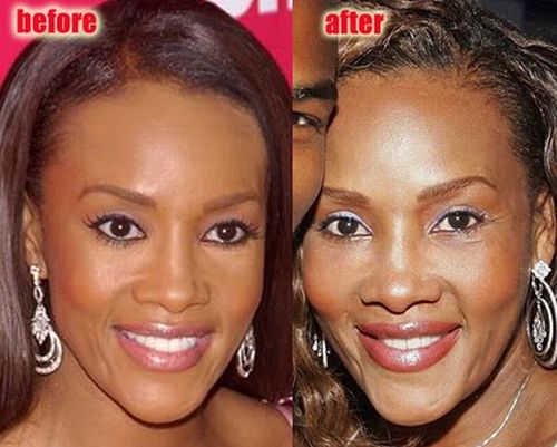 Vivica Fox plastic surgery before and after