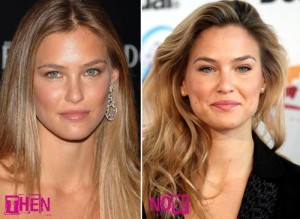 Bar Refaeli Plastic Surgery Before and After