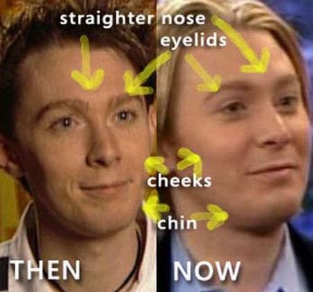 Clay Aiken plastic surgery before and after