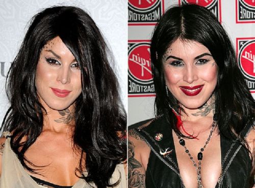 Kat Von D breast implants before and after