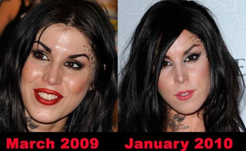 Kat Von D plastic surgery before and after