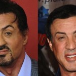 Sylvester Stallone plastic surgery before and after