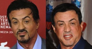 Sylvester Stallone Plastic Surgery Before and After