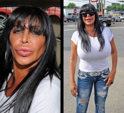 Plastic Surgery Gone Wrong: 15 Worst Celebrity Plastic Surgery